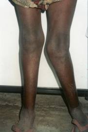 Original photograph illustrating skeletal changes associated with fluorosis